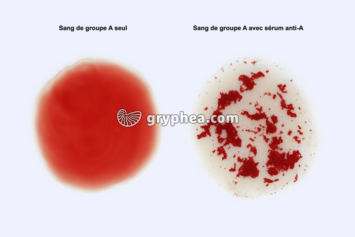 Réaction d'agglutination d'hématies A avec sérum anti-A - gryphea.com